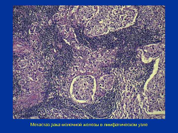 Метастаз рака в лимфатический узел. Метастаз аденокарциномы в лимфатический узел микропрепарат. Метастазы в лимфатические узлы.