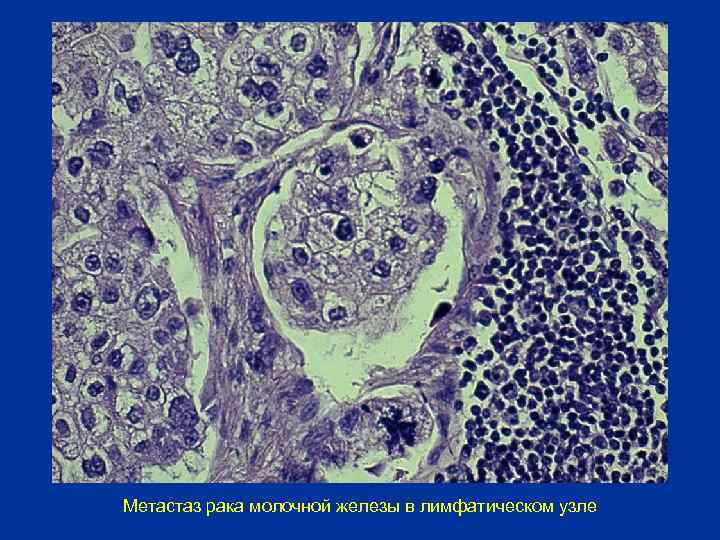 Метастатические лимфоузлы. Метастазы в лимфатический узел гистология. Муцинозная аденокарцинома желудка гистология. Метастаз в лимфоузел микропрепарат.