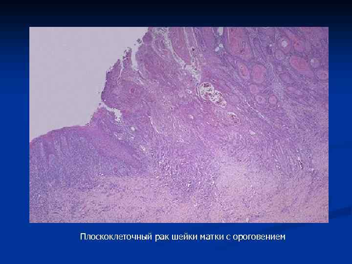Плоскоклеточный неороговевающий рак матки