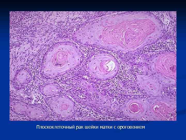 Плоскоклеточный рак шейки матки с ороговением 