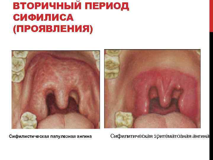 ВТОРИЧНЫЙ ПЕРИОД СИФИЛИСА (ПРОЯВЛЕНИЯ) Сифилистическая папулезная ангина Сифилитическая эритематозная ангина 