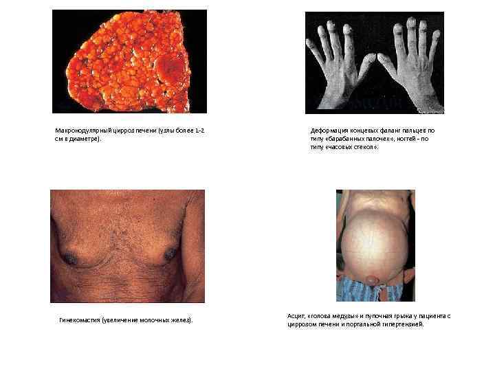 Макронодулярный цирроз печени (узлы более 1 -2 см в диаметре). Гинекомастия (увеличение молочных желез).