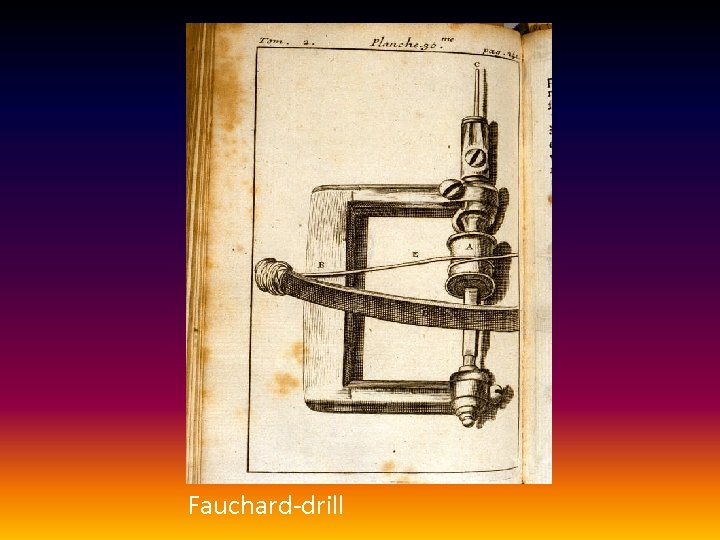 Fauchard-drill 