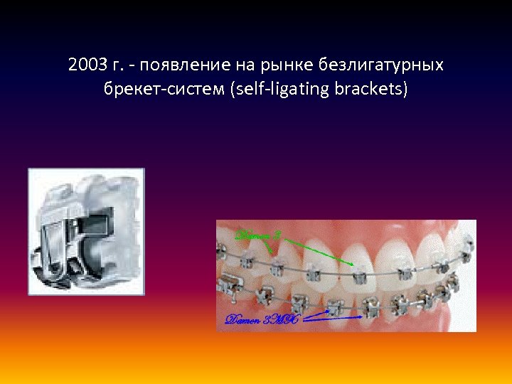 2003 г. - появление на рынке безлигатурных брекет-систем (self-ligating brackets) 
