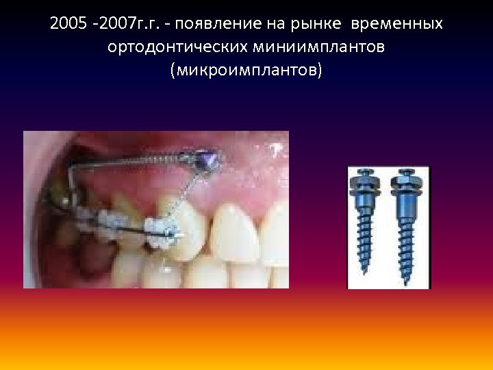 2005 -2007 г. г. - появление на рынке временных ортодонтических миниимплантов (микроимплантов) 