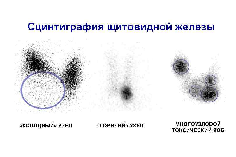 Сцинтиграфия щитовидной железы «ХОЛОДНЫЙ» УЗЕЛ «ГОРЯЧИЙ» УЗЕЛ МНОГОУЗЛОВОЙ ТОКСИЧЕСКИЙ ЗОБ 