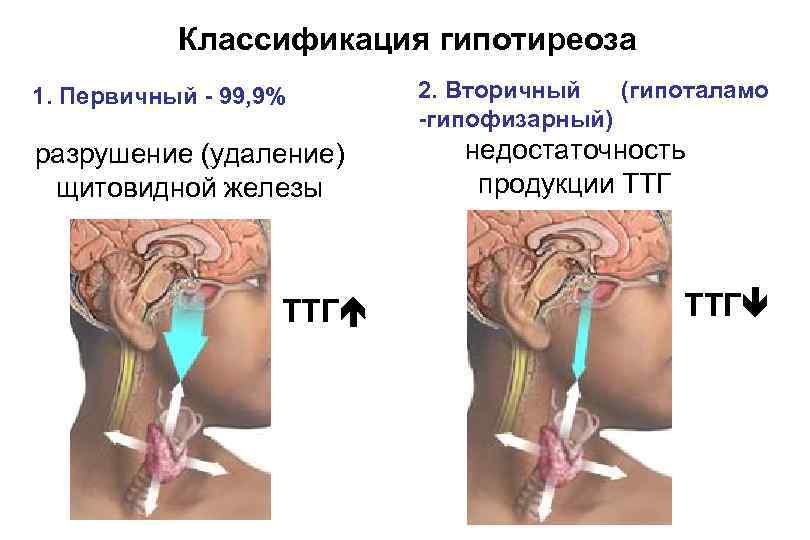 Классификация гипотиреоза 1. Первичный - 99, 9% разрушение (удаление) щитовидной железы ТТГ 2. Вторичный