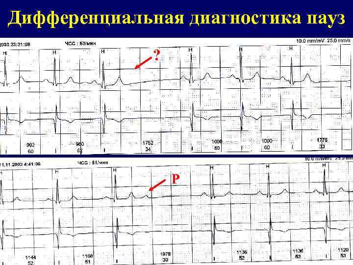 Экг ад. Паузы ритма при холтеровском мониторировании у детей. Паузы ритма при холтеровском мониторировании норма. Клинически значимая пауза на ЭКГ что. Паузы на Холтере норма.