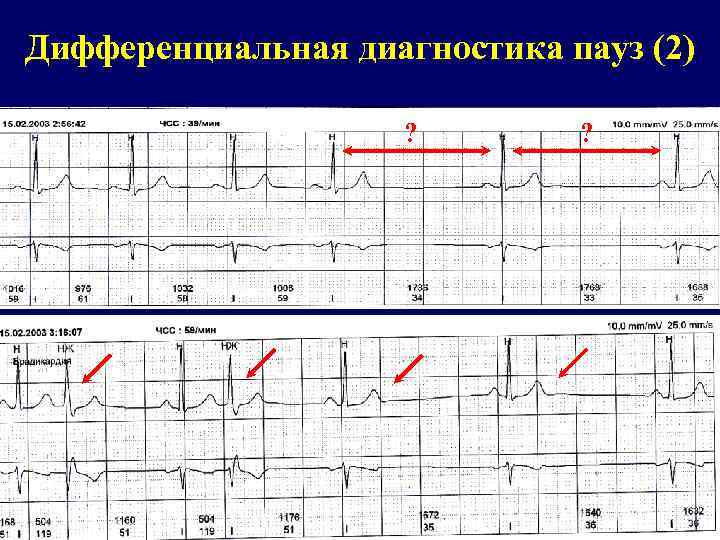 Дифференциальная диагностика пауз (2) ? ? 