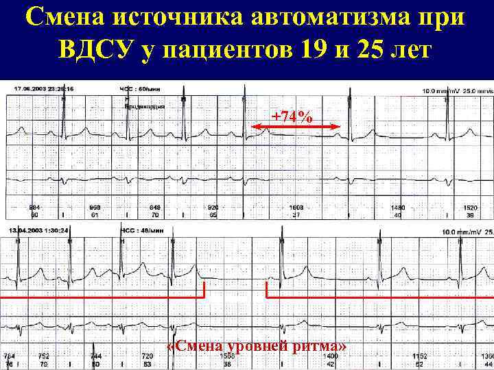 Смена источника автоматизма при ВДСУ у пациентов 19 и 25 лет +74% «Смена уровней