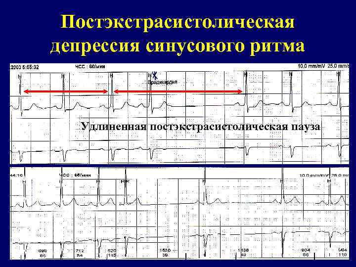 Постэкстрасистолическая депрессия синусового ритма Удлиненная постэкстрасистолическая пауза 