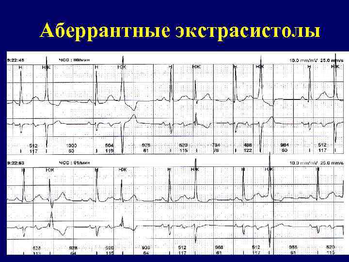 Аберрантные экстрасистолы 