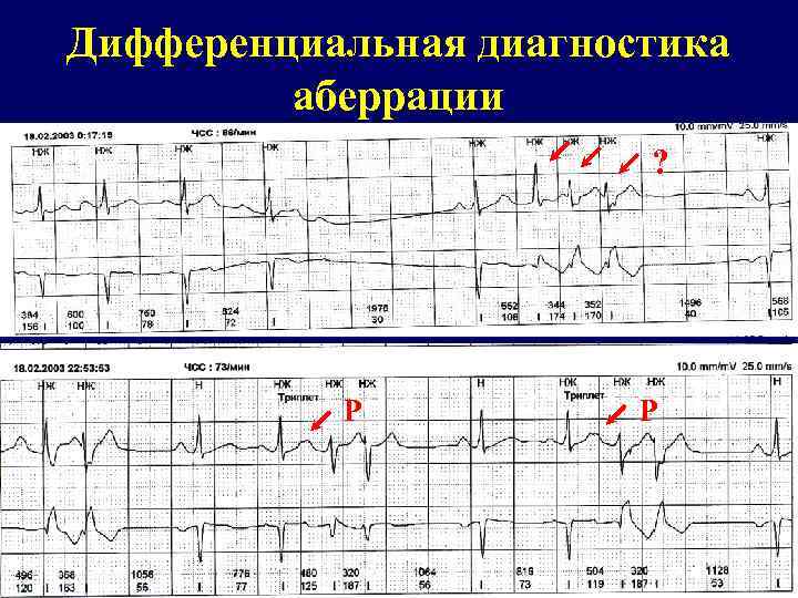 Дифференциальная диагностика аберрации ? Р Р 