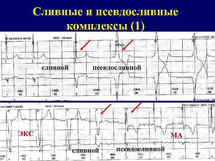 Сливные и псевдосливные комплексы (1) сливной псевдосливной ЭКС МА сливной псевдосливной 