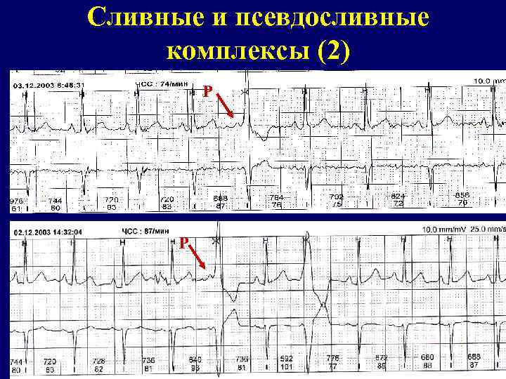 Сливные и псевдосливные комплексы (2) Р Р 