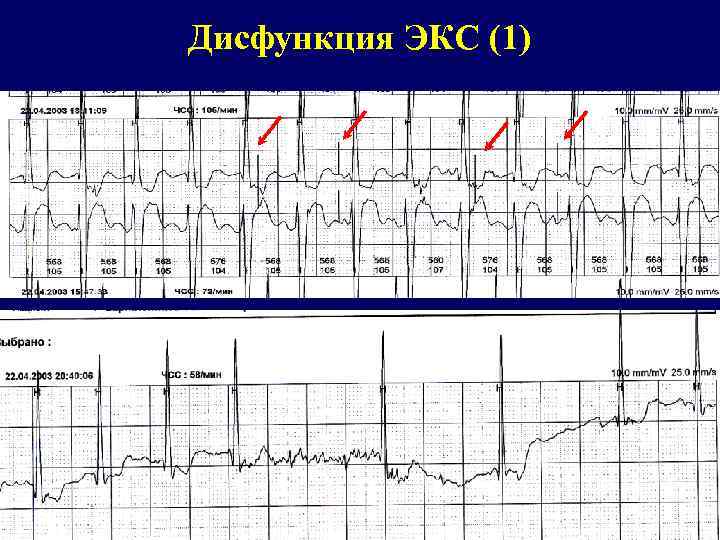 Дисфункция ЭКС (1) 