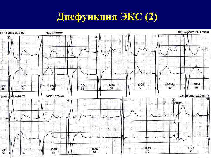 Дисфункция ЭКС (2) 