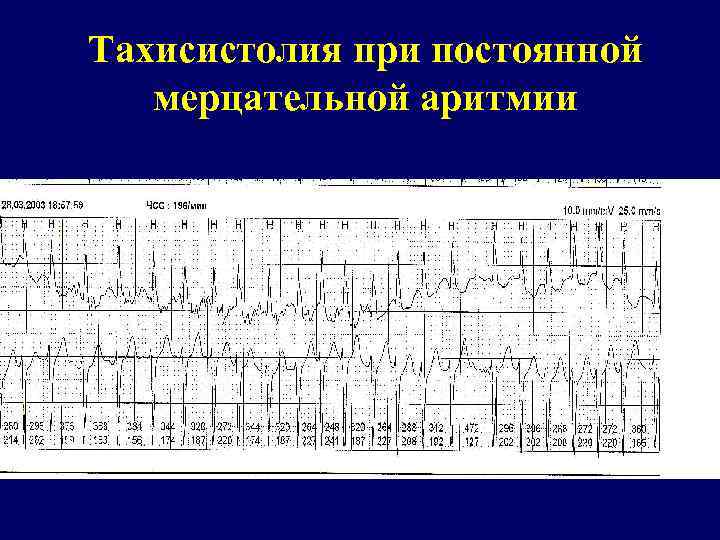 Тахисистолия при постоянной мерцательной аритмии 