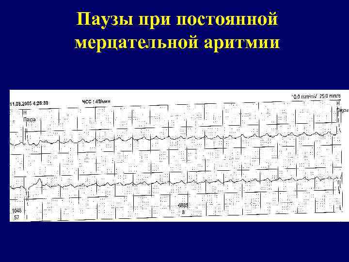 Паузы при постоянной мерцательной аритмии 