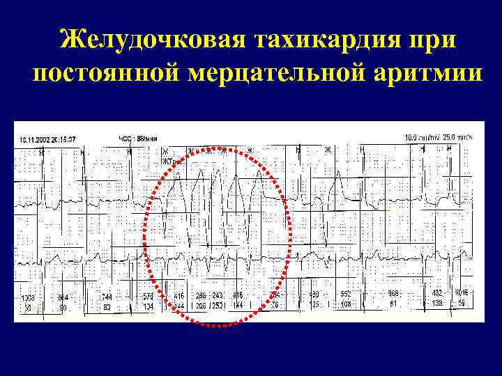 Желудочковая тахикардия при постоянной мерцательной аритмии 