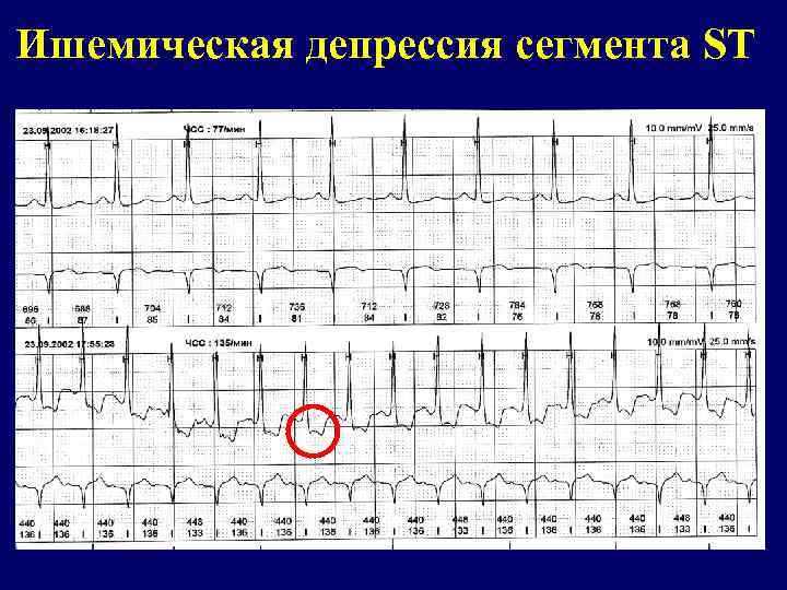 Ишемическая депрессия сегмента ST 