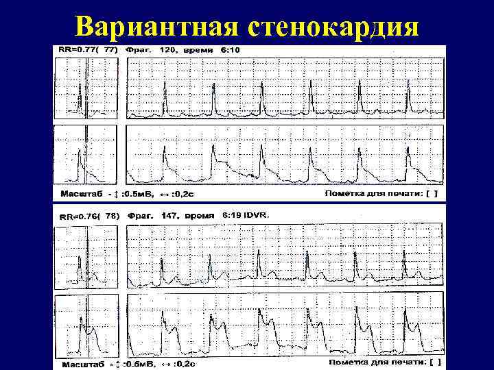 Вариантная стенокардия 