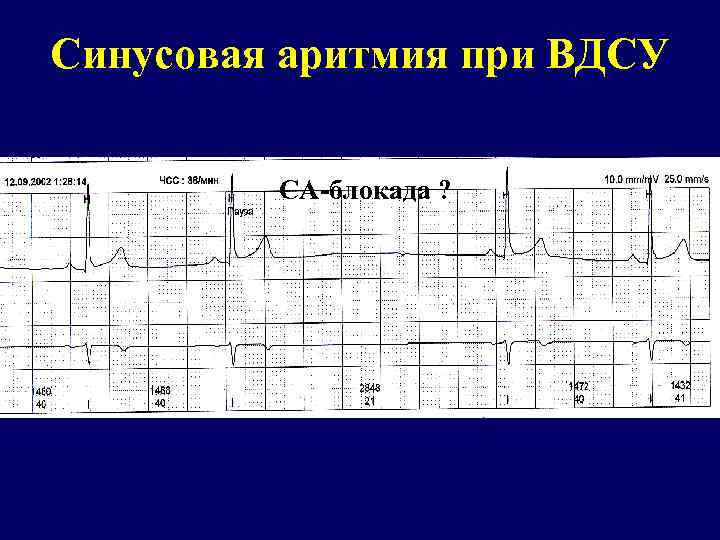 Синусовая аритмия при ВДСУ СА-блокада ? 