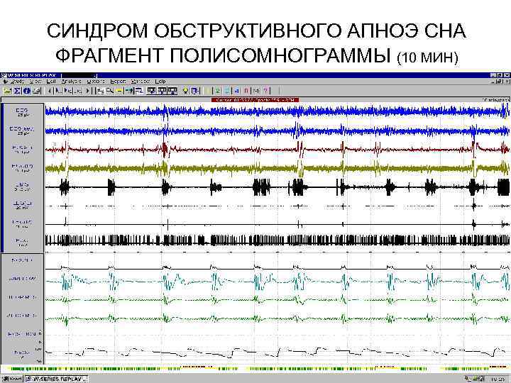 СИНДРОМ ОБСТРУКТИВНОГО АПНОЭ СНА ФРАГМЕНТ ПОЛИСОМНОГРАММЫ (10 МИН) Индекс апноэ/гипопноэ - 60 в час,