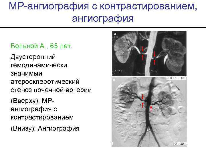 МР-ангиография с контрастированием, ангиография Больной А. , 65 лет. Двусторонний гемодинамически значимый атеросклеротический стеноз