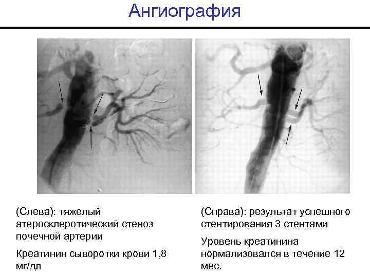 Ангиография (Слева): тяжелый атеросклеротический стеноз почечной артерии Креатинин сыворотки крови 1, 8 мг/дл (Справа):