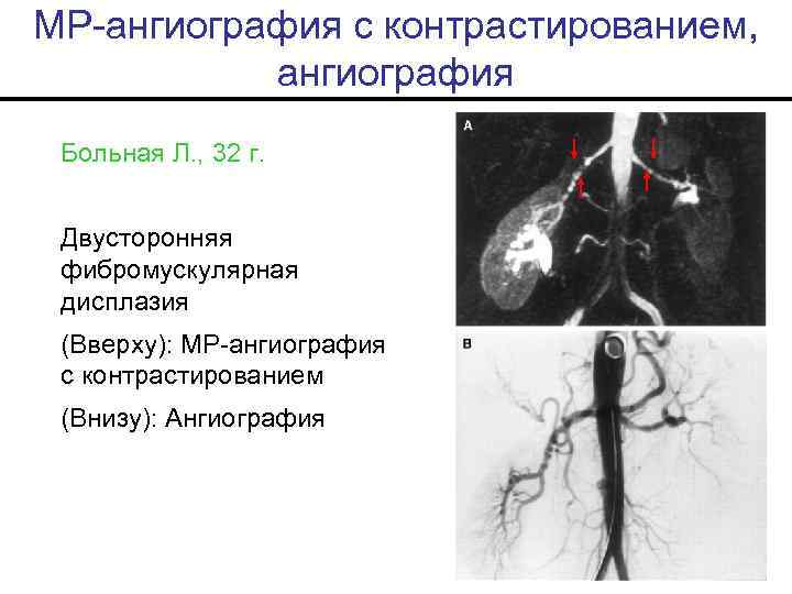 МР-ангиография с контрастированием, ангиография Больная Л. , 32 г. Двусторонняя фибромускулярная дисплазия (Вверху): МР-ангиография