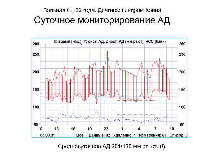 Больная С. , 32 года. Диагноз: синдром Конна Суточное мониторирование АД Среднесуточное АД 201/130