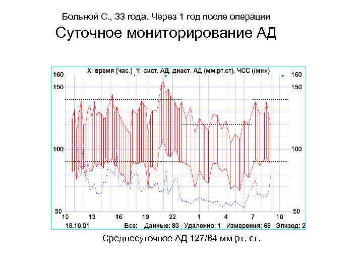 Больной С. , 33 года. Через 1 год после операции Суточное мониторирование АД Среднесуточное