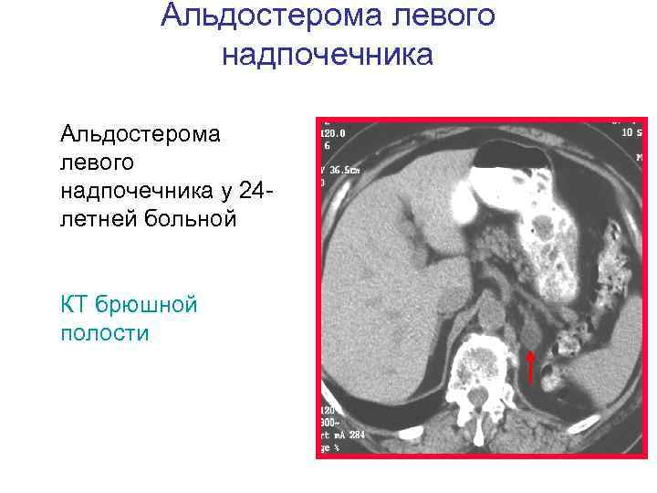 Альдостерома левого надпочечника у 24 летней больной КТ брюшной полости 