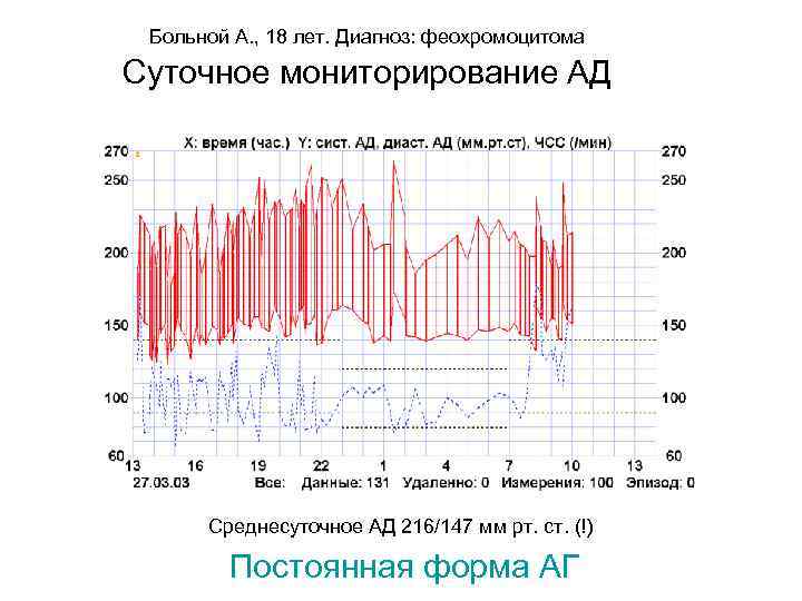 Больной А. , 18 лет. Диагноз: феохромоцитома Суточное мониторирование АД Среднесуточное АД 216/147 мм