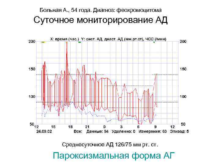 Больная А. , 54 года. Диагноз: феохромоцитома Суточное мониторирование АД Среднесуточное АД 126/75 мм