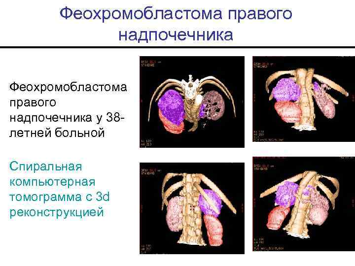Феохромобластома правого надпочечника у 38 летней больной Спиральная компьютерная томограмма с 3 d реконструкцией