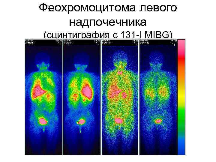 Феохромоцитома левого надпочечника (сцинтиграфия с 131 -I MIBG) 