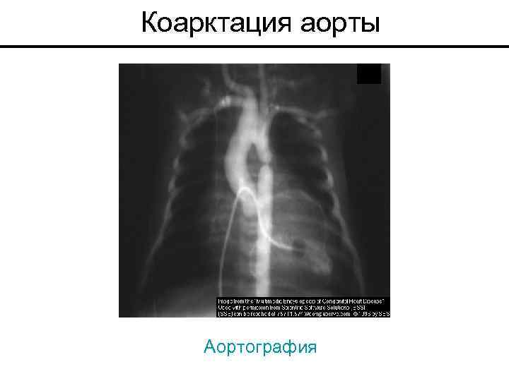 Коарктация аорты Аортография 