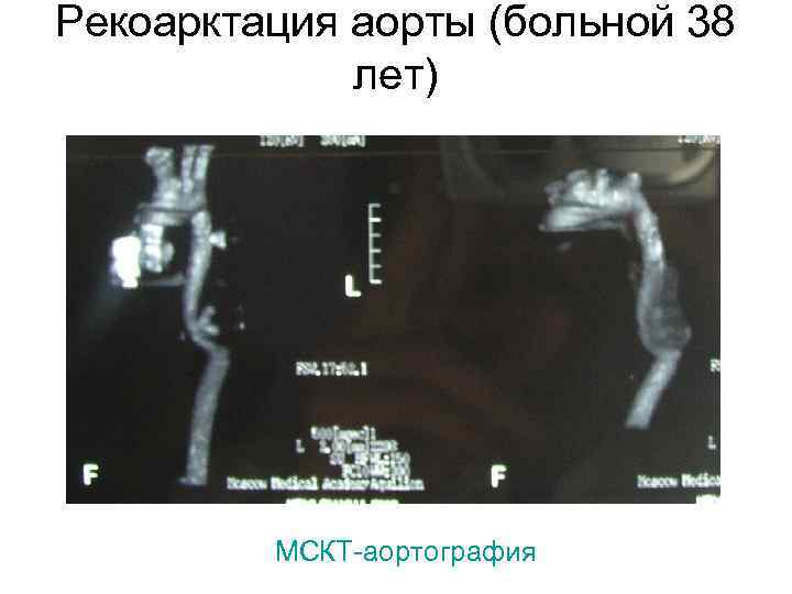 Рекоарктация аорты (больной 38 лет) МСКТ-аортография 