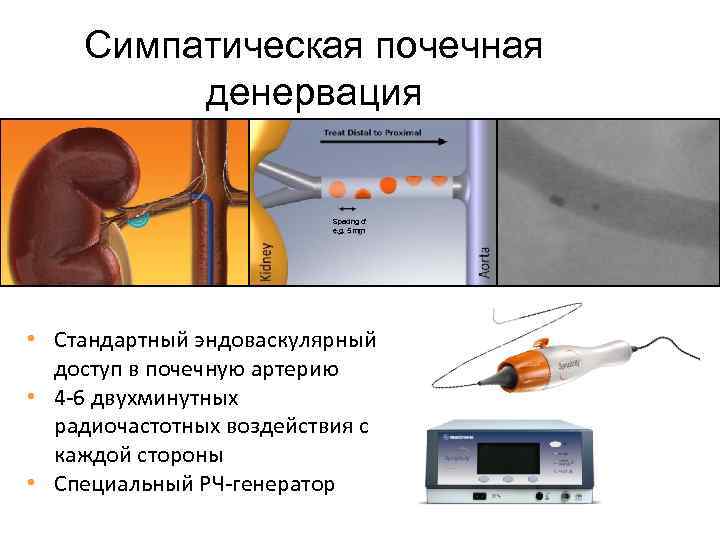 Симпатическая почечная денервация Spacing of e. g. 5 mm. • Стандартный эндоваскулярный доступ в