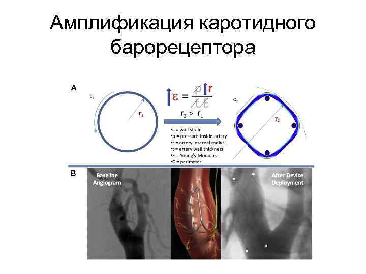 Амплификация каротидного барорецептора 