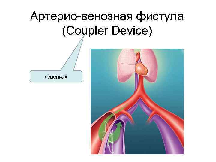 Артерио-венозная фистула (Coupler Device) «сцепка» 