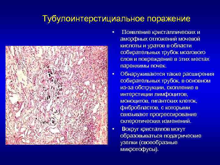 Тубулоинтерстициальное поражение • • • Появление кристаллических и аморфных отложений мочевой кислоты и уратов