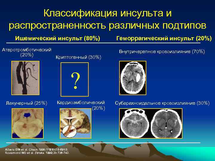 Классификация инсульта и распространенность различных подтипов Ишемический инсульт (80%) Атеротромботический (20%) Криптогенный (30%) Геморрагический