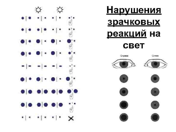 Нарушения зрачковых реакций на свет 