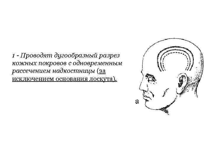 1 - Проводят дугообразный разрез кожных покровов с одновременным рассечением надкостницы (за исключением основания