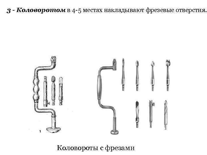 3 - Коловоротом в 4 -5 местах накладывают фрезевые отверстия. Коловороты с фрезами 