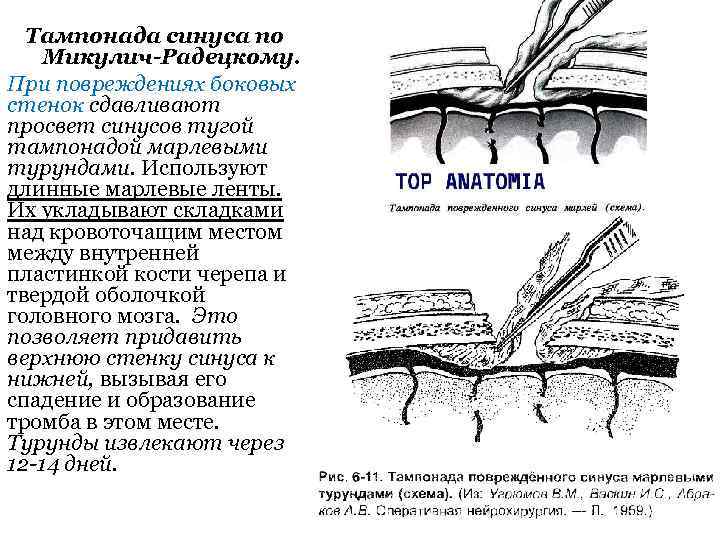 Тампон фон микулича радецкого