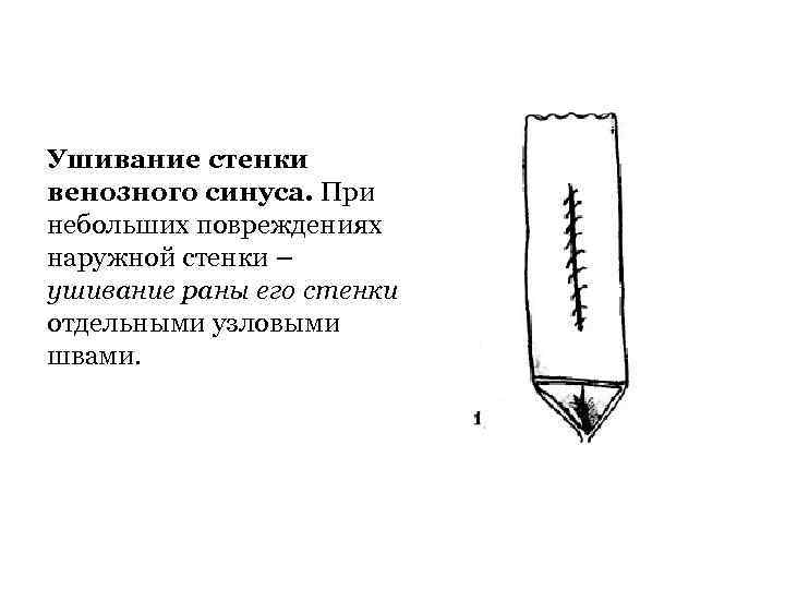 Ушивание стенки венозного синуса. При небольших повреждениях наружной стенки – ушивание раны его стенки